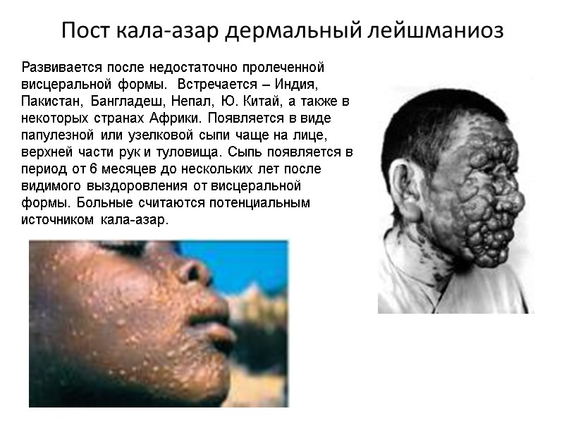 Пост кала-азар дермальный лейшманиоз Развивается после недостаточно пролеченной висцеральной формы.  Встречается – Индия,